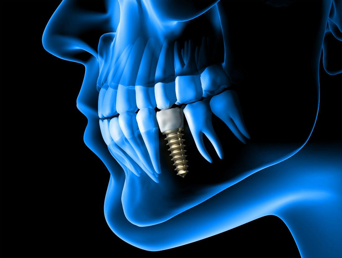 Dental Implants Fargo, ND
